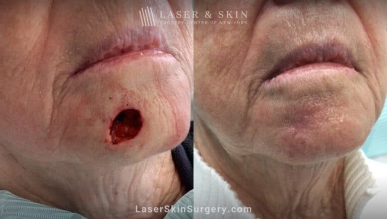 Mohs surgery to remove skin cancer on chin