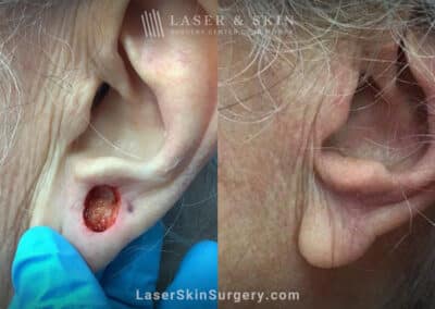 Mohs surgery to remove skin cancer on the ear