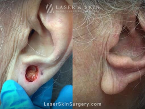 Mohs surgery to remove skin cancer on the ear