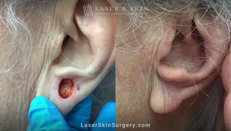 Mohs surgery to remove skin cancer on the ear