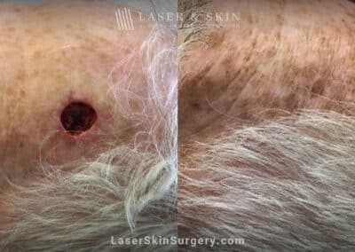 Mohs surgery to remove skin cancer on scalp