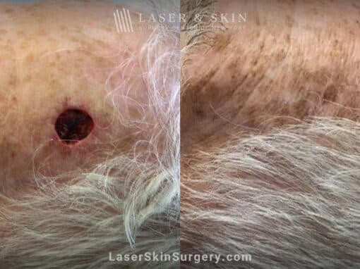 Mohs surgery to remove skin cancer on scalp