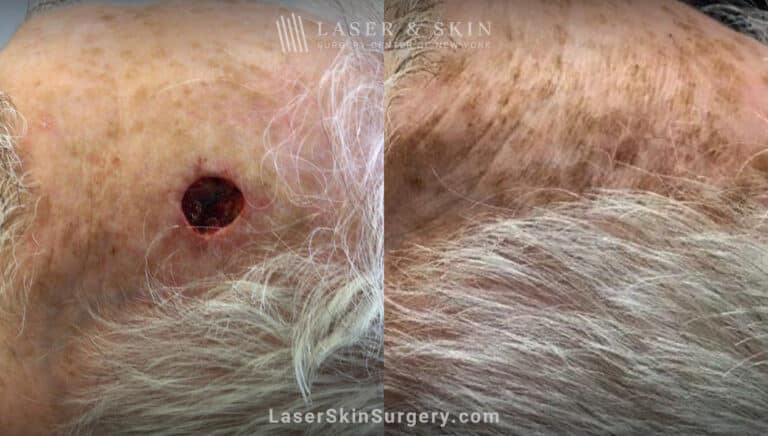 Mohs surgery to remove skin cancer on scalp