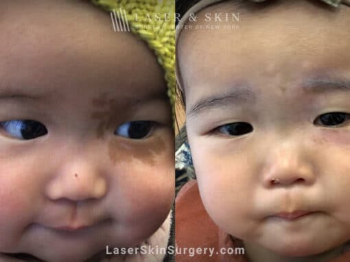 PicoPlus laser to treat Café au lait macule on child’s face