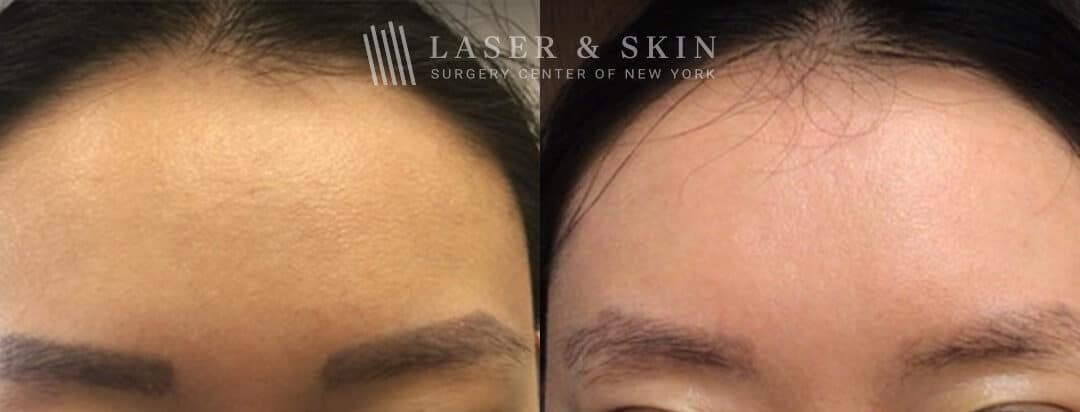 PicoSure laser to remove eyebrow tattoos