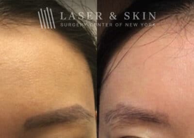 PicoSure laser to remove eyebrow tattoos