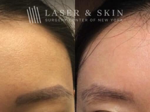 PicoSure laser to remove eyebrow tattoos