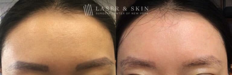 PicoSure laser to remove eyebrow tattoos