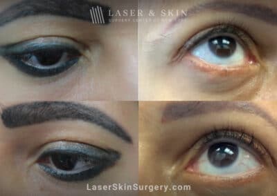 PicoSure laser to remove eyelid tattoo in two treatments
