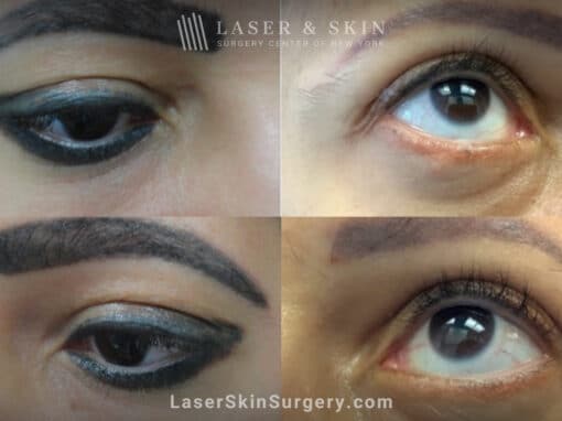 PicoSure laser to remove eyelid tattoo in two treatments