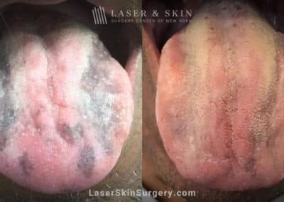 Ruby laser used to remove benign pigmentation from tongue