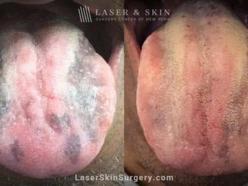 Ruby laser used to remove benign pigmentation from tongue