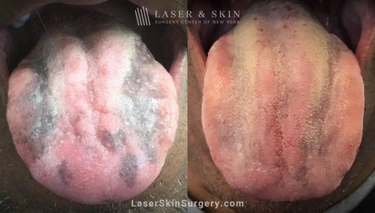 Ruby-Laser-to-treat-benign-tongue-pigmentation-LSSC-NYC