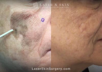 Ruby and PicoPlus lasers used to remove benign lesion on cheek