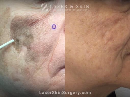 Ruby and PicoPlus lasers used to remove benign lesion on cheek