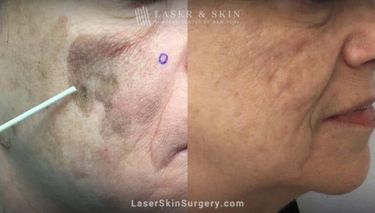 Ruby and PicoPlus lasers used to remove benign lesion on cheek