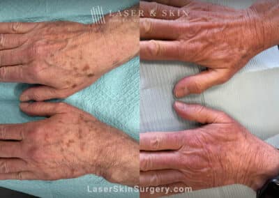 Ruby laser to remove lentigines (brown spots) from the backs of the hands