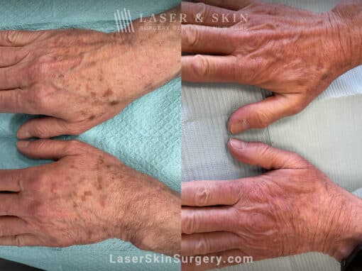 Ruby laser to remove lentigines (brown spots) from the backs of the hands