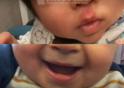 Vbeam laser to treat port wine birthmark above child’s lip