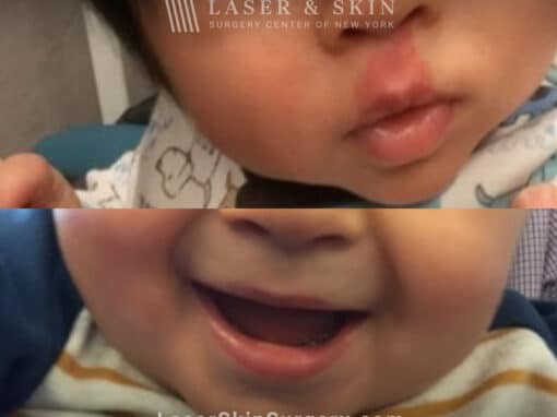 Vbeam laser to treat port wine birthmark above child’s lip