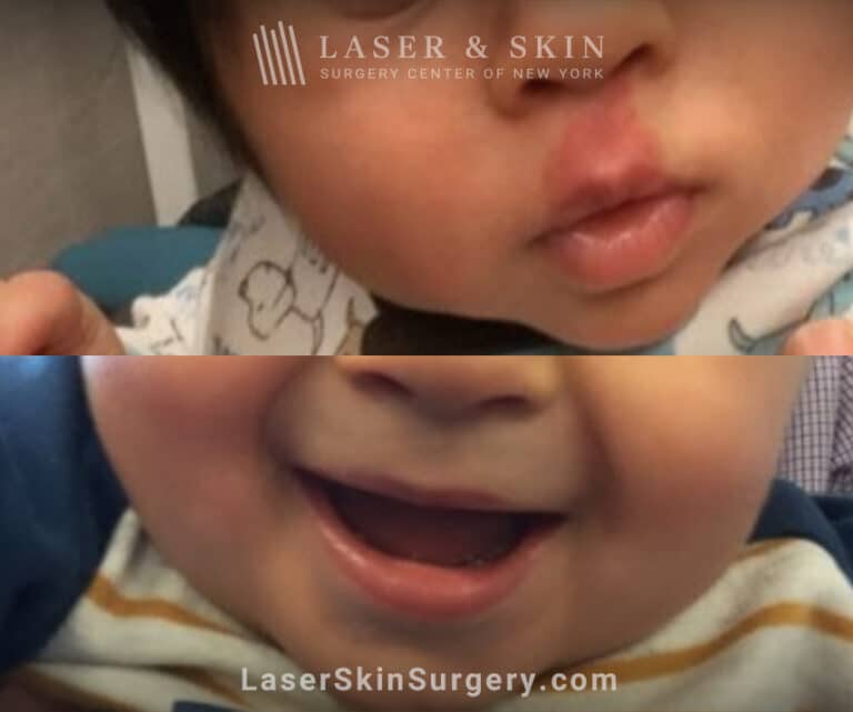 Vbeam laser to treat port wine birthmark above child’s lip