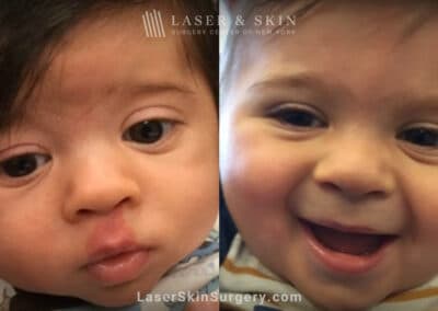 Vbeam laser to treat port wine birthmark above infant’s lip