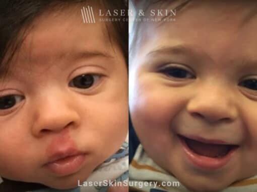 Vbeam laser to treat port wine birthmark above infant’s lip