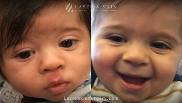 Vbeam laser to treat port wine birthmark above infant’s lip