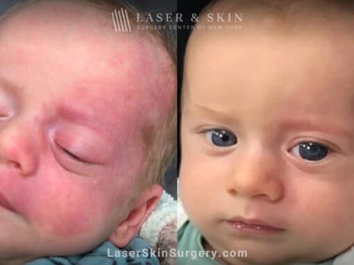 Vbeam laser to treat port wine birthmark on infant’s face