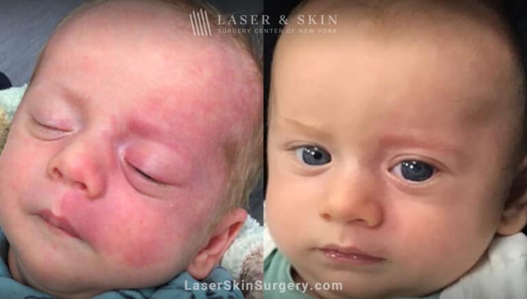 Vbeam laser to treat port wine birthmark on infant’s face