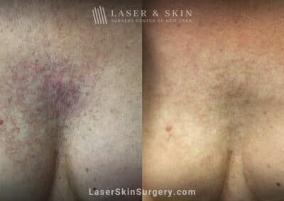 Vbeam laser to treat visible veins on chest after radiation treatment