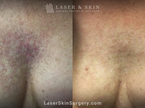 Vbeam laser to treat visible veins on chest after radiation treatment