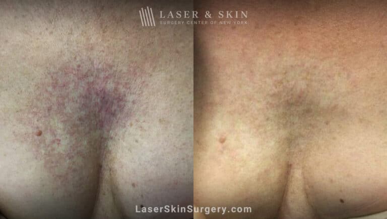 Vbeam laser to treat visible veins on chest after radiation treatment