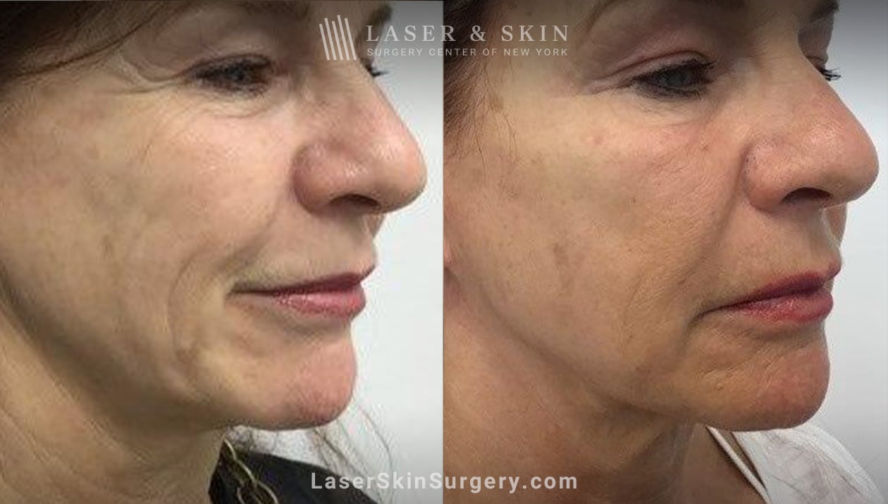 face and neck skin tightening-NY-NY before and after results of Sofwave skin tightening treatment in NY, NY