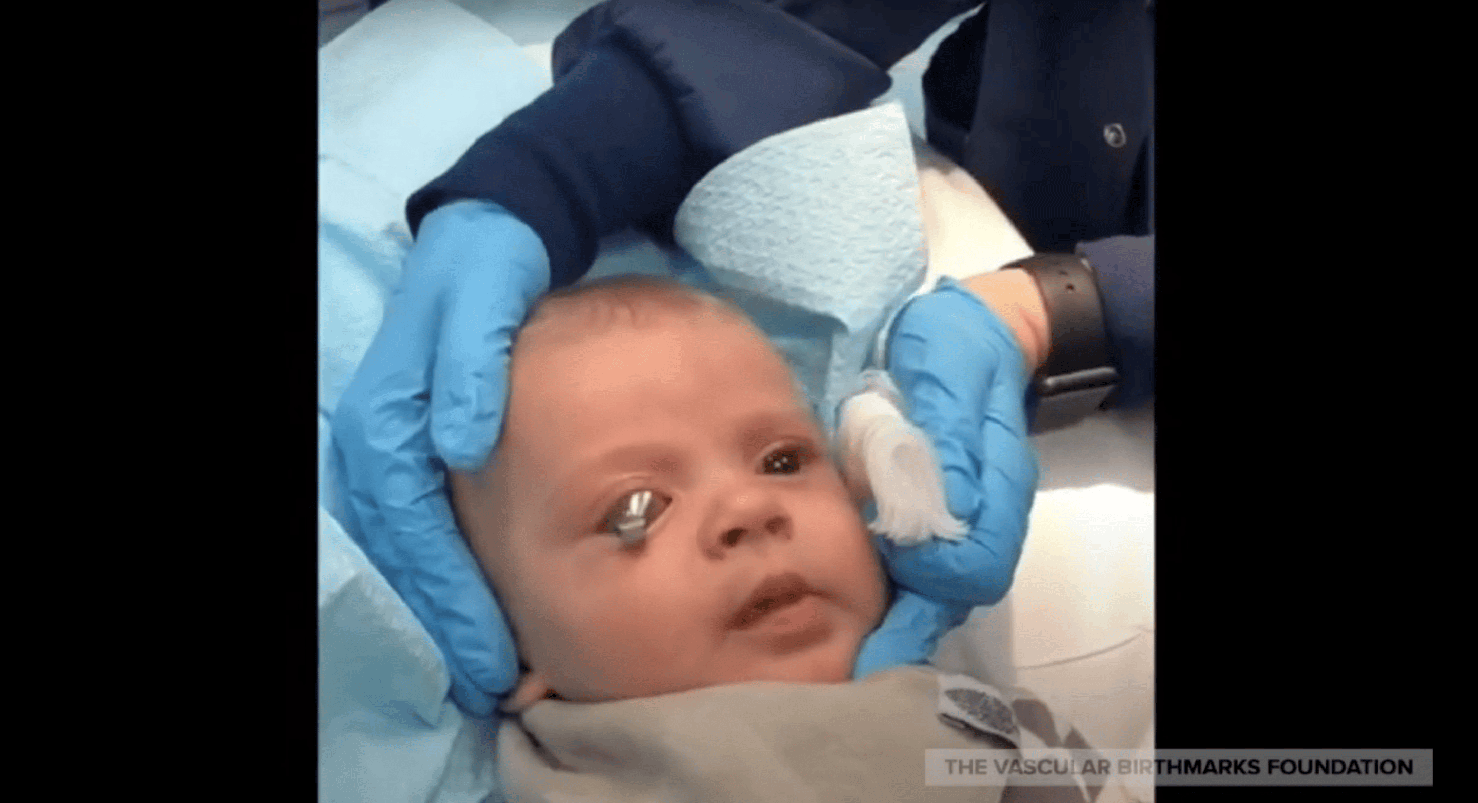 Dr. Roy Geronemus demonstrates the use of the corneal shield for protecting the eye while lasering an orbital or eyelid port wine stain or hemangioma, NYC.