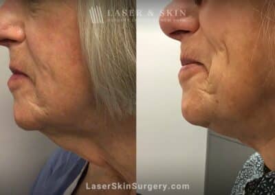 Cervicoplasty to treat turkey neck