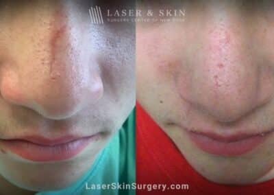 Fraxel® Repair CO2 laser to treat scar on nose