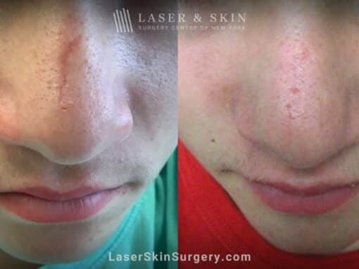 Fraxel® Repair CO2 laser to treat scar on nose