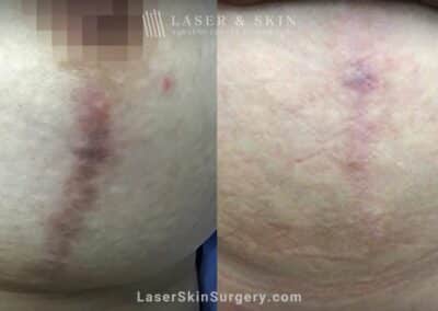 LaseMD treatments for breast scar removal