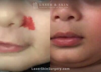 Vbeam laser treatments to remove hemangioma