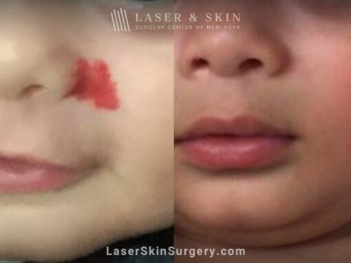 Vbeam laser treatments to remove hemangioma