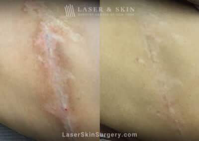 6 Fraxel laser treatments to reduce scarring
