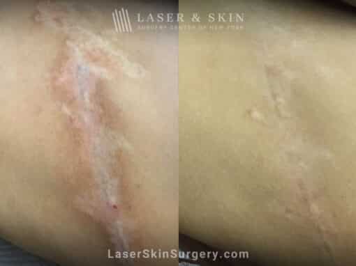 6 Fraxel laser treatments to reduce scarring