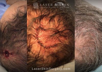 Mohs Surgery for Skin Cancer on the Scalp