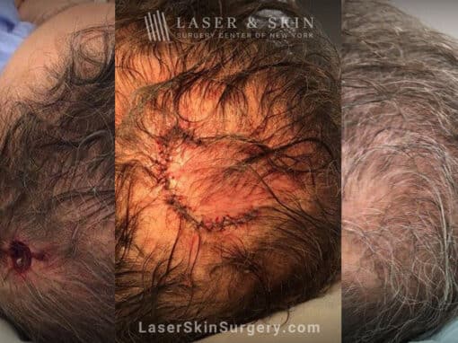 Mohs Surgery for Skin Cancer on the Scalp