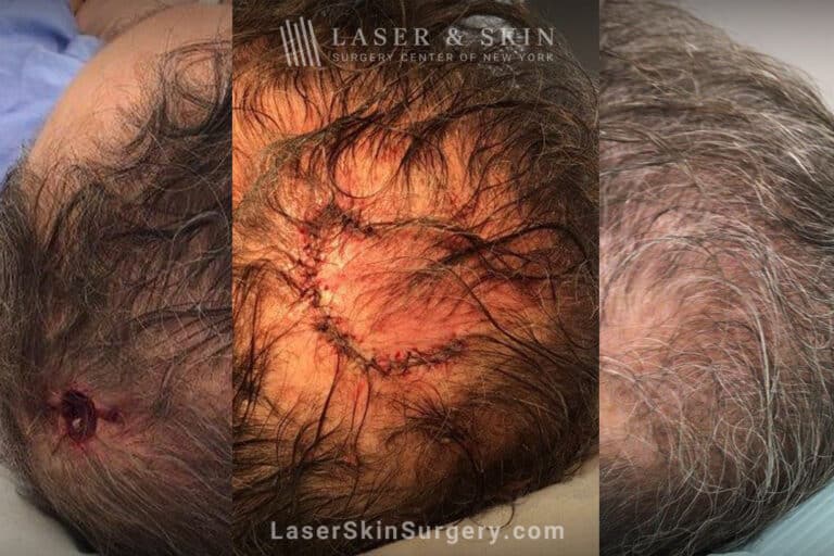 Mohs Surgery for Skin Cancer on the Scalp