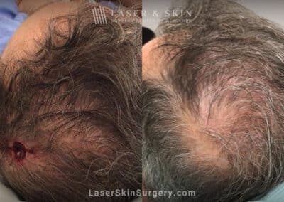 Mohs Surgery for Skin Cancer on the Scalp