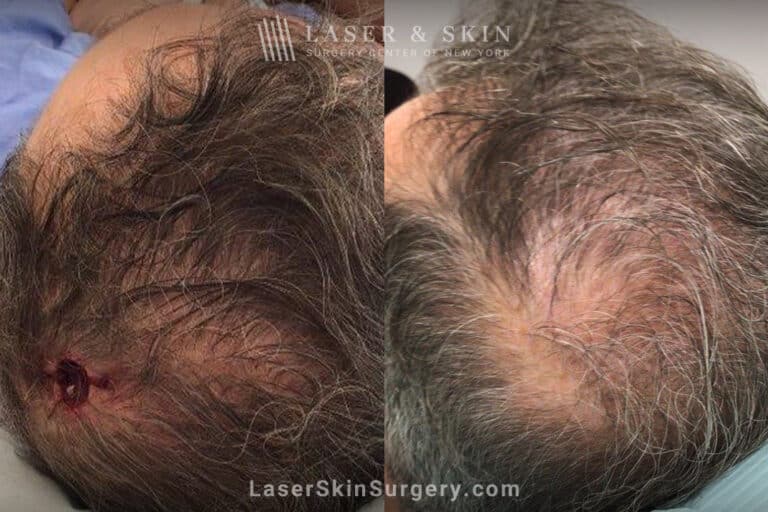 Mohs Surgery for Skin Cancer on the Scalp