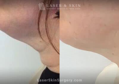 ThermiTight for Neck Rejuvenation