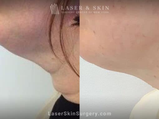 ThermiTight for Neck Rejuvenation